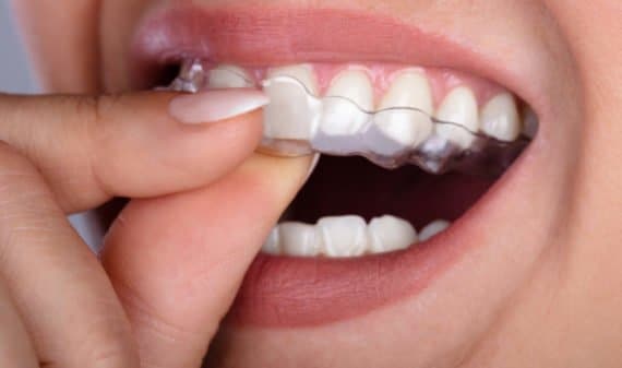 Invisalign & ClearCorrect