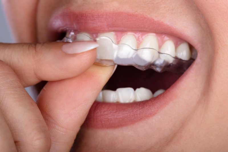 Invisalign & ClearCorrect