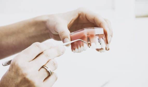 Implantes dentales brickell