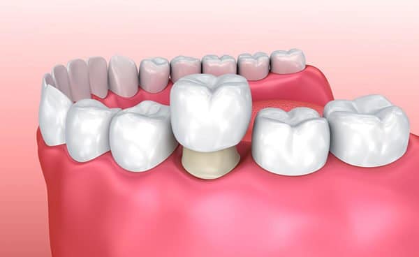 Corona de dientes