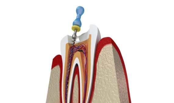 root canal treatment