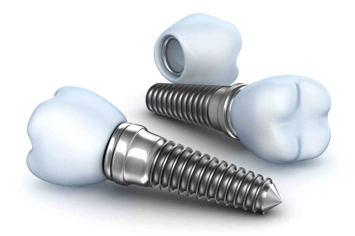 What are Dental Implants