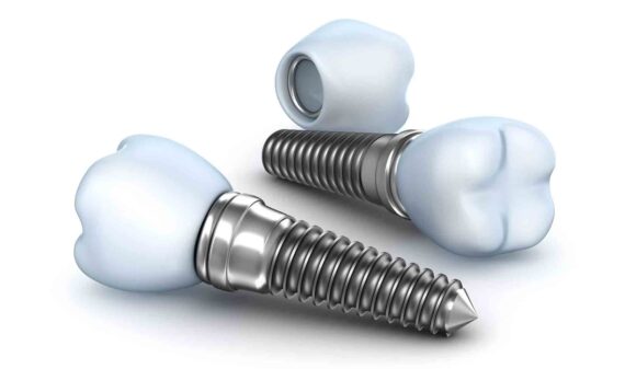 What are Dental Implants