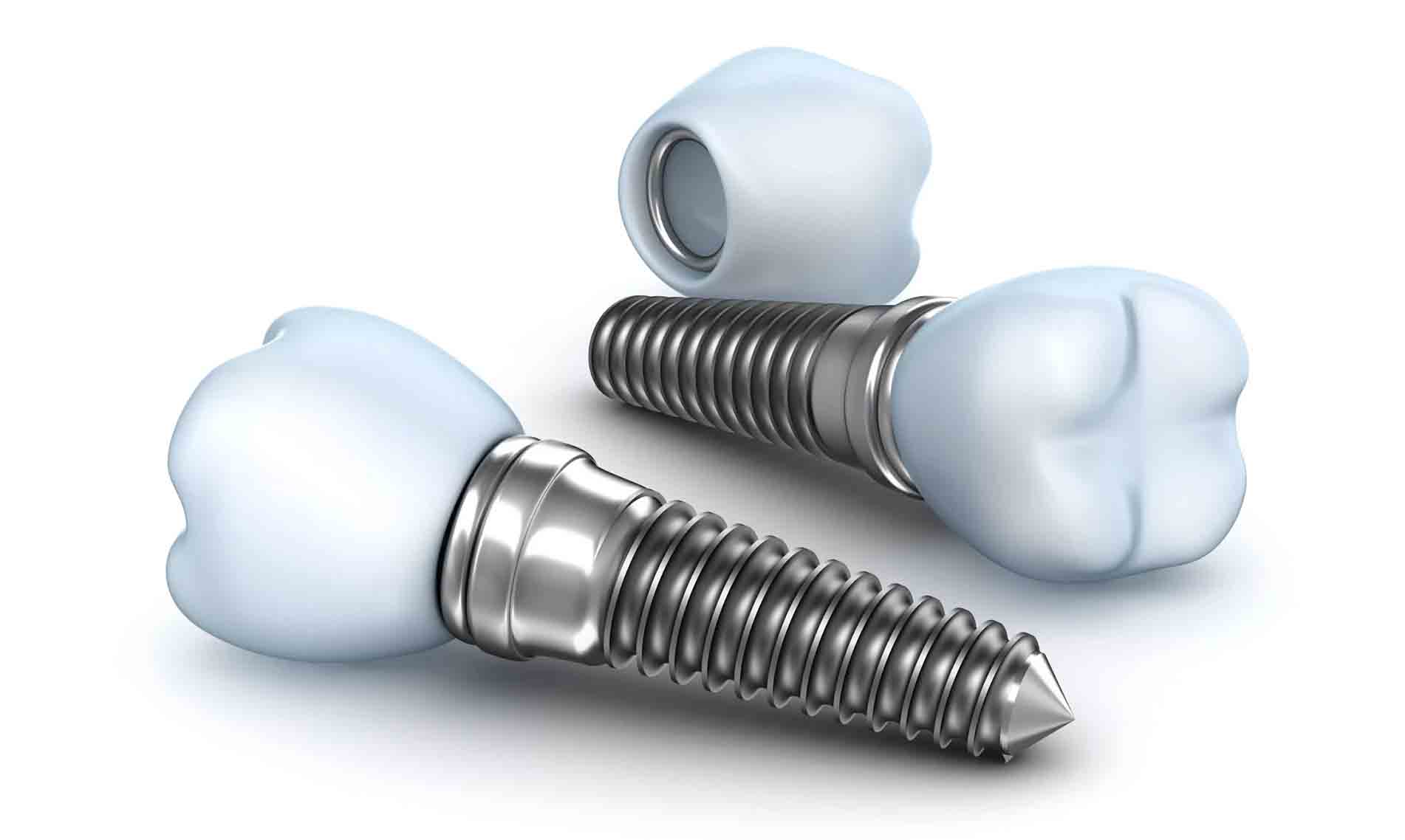 What are Dental Implants