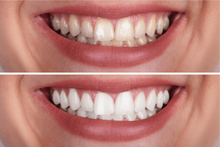 zoom teeth whitening