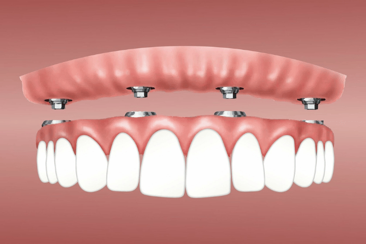 All-on-4 dental implants