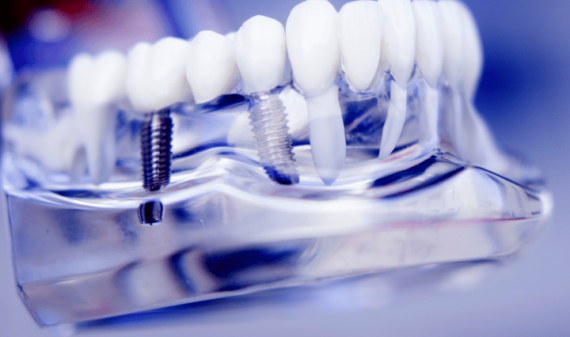 Dental Implant Care