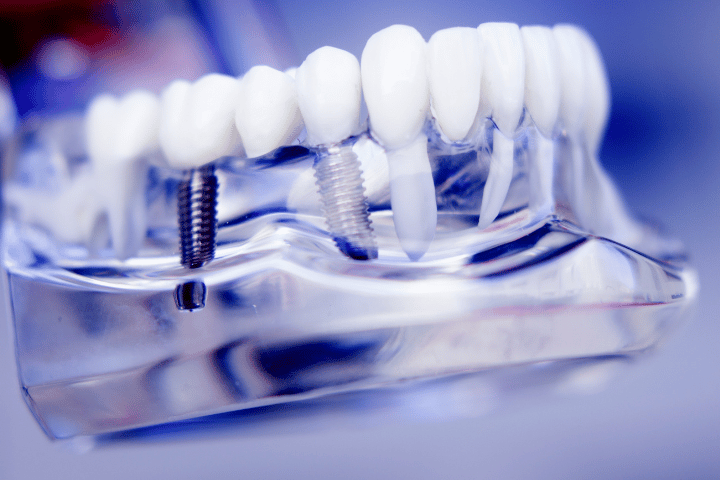 Dental Implant Care