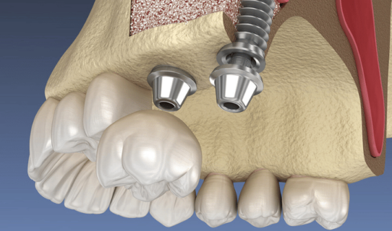 upper jaw implants